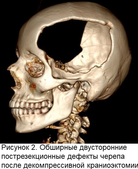 🧠 Современные возможности нейрохирургии и нейрореанимации позволяют не только спасать ранее практиче