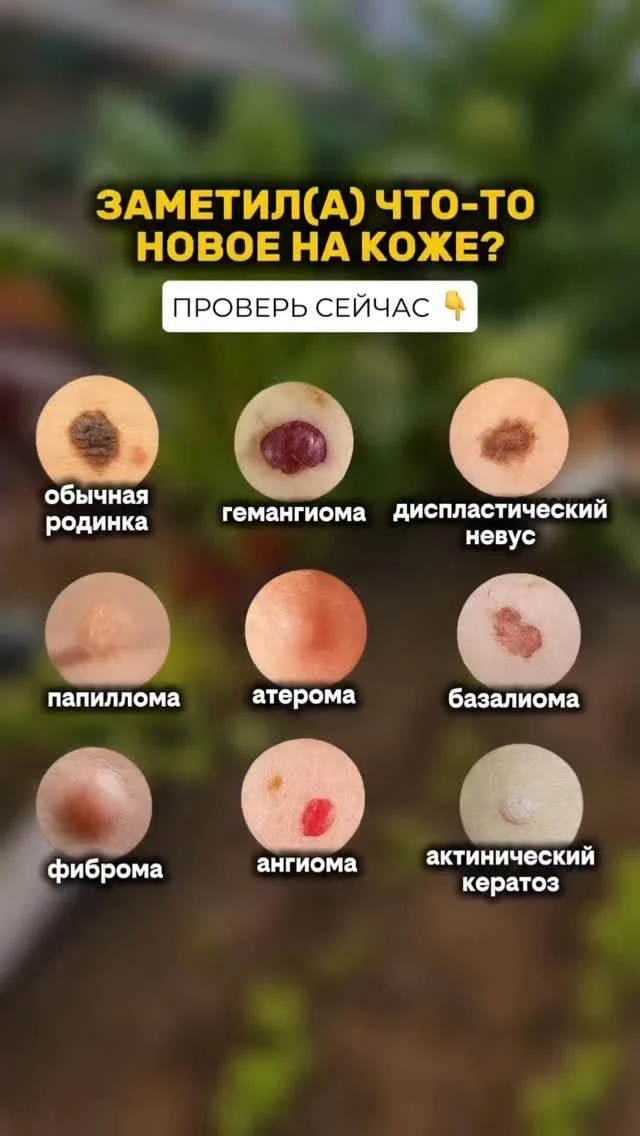 Что появилось на вашей коже? Разбираемся в новообразованиях 🌡️

Сегодня поговорим о том, на что сто