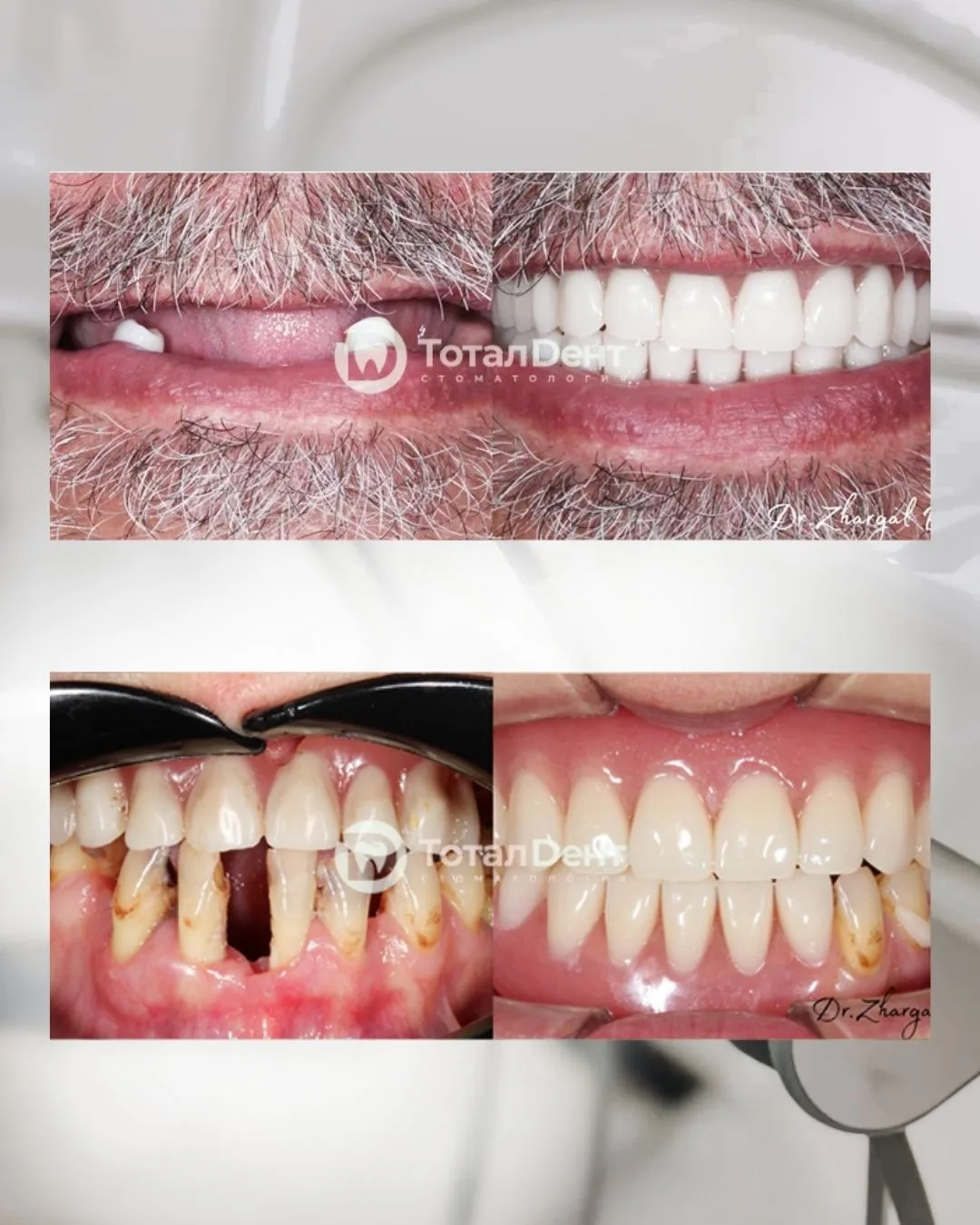 Результаты работы наших ортопедов 🦷