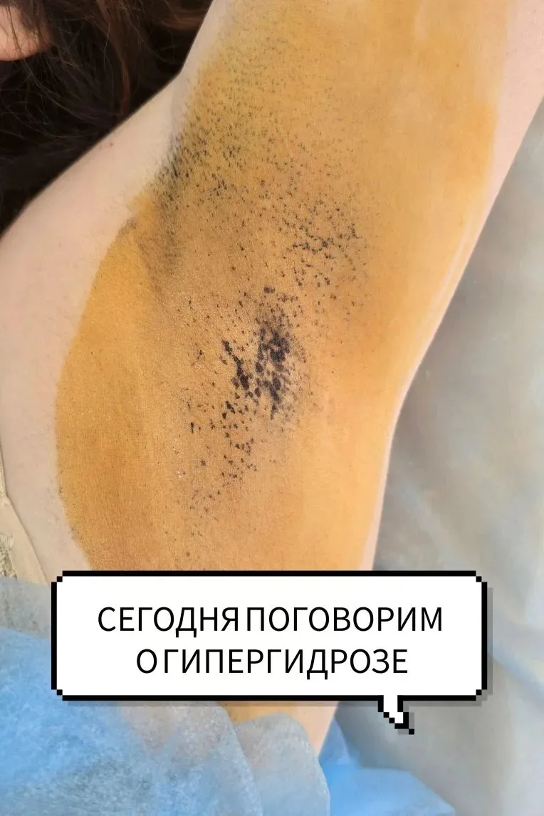 🔥ДО КОНЦА ИЮНЯ - 10%🔥

✅Гипергидроз — это когда человек потеет намного сильнее, чем нужно для обыч