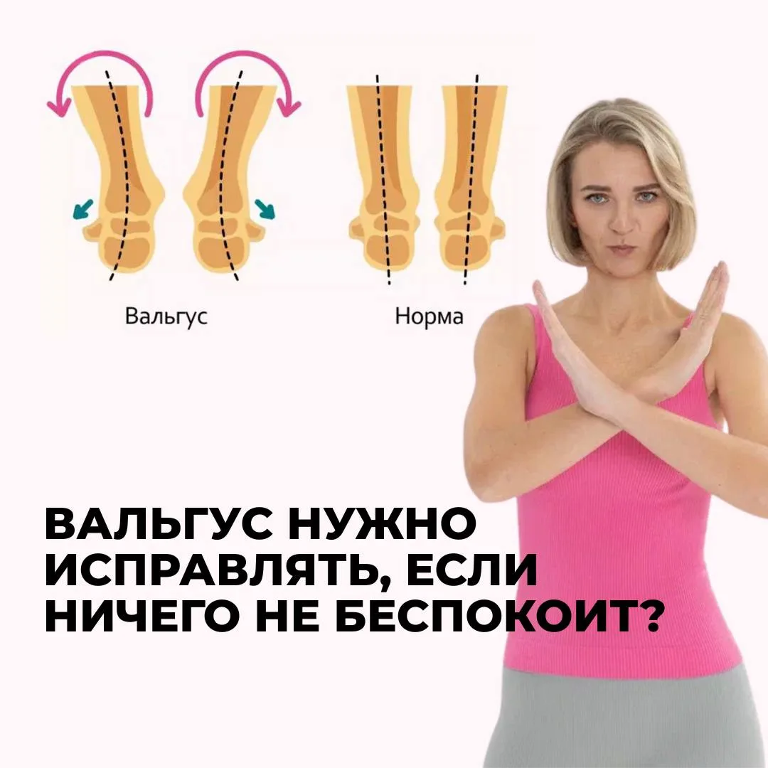 🔥 ВАЛЬГУС НЕ НУЖНО ИСПРАВЛЯТЬ, если ничего не беспокоит? Точно ничего? Или просто ещё не беспокоит?…
