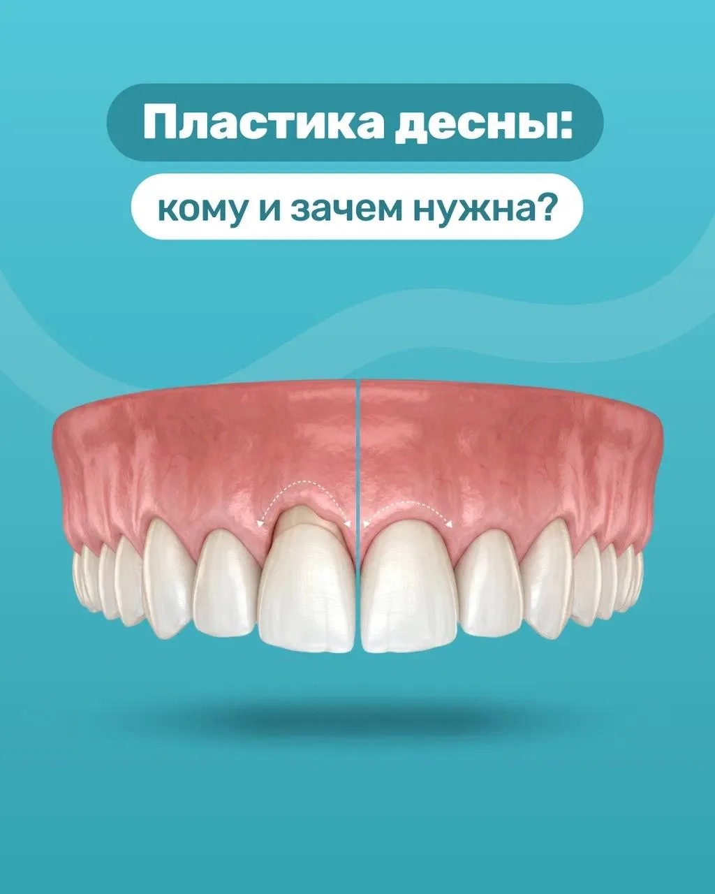 ⚡️ Пластика десны: всё, что нужно знать!