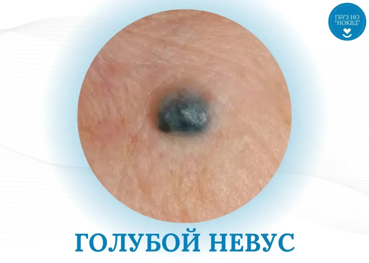 Голубой невус: почему родинка не коричневая?