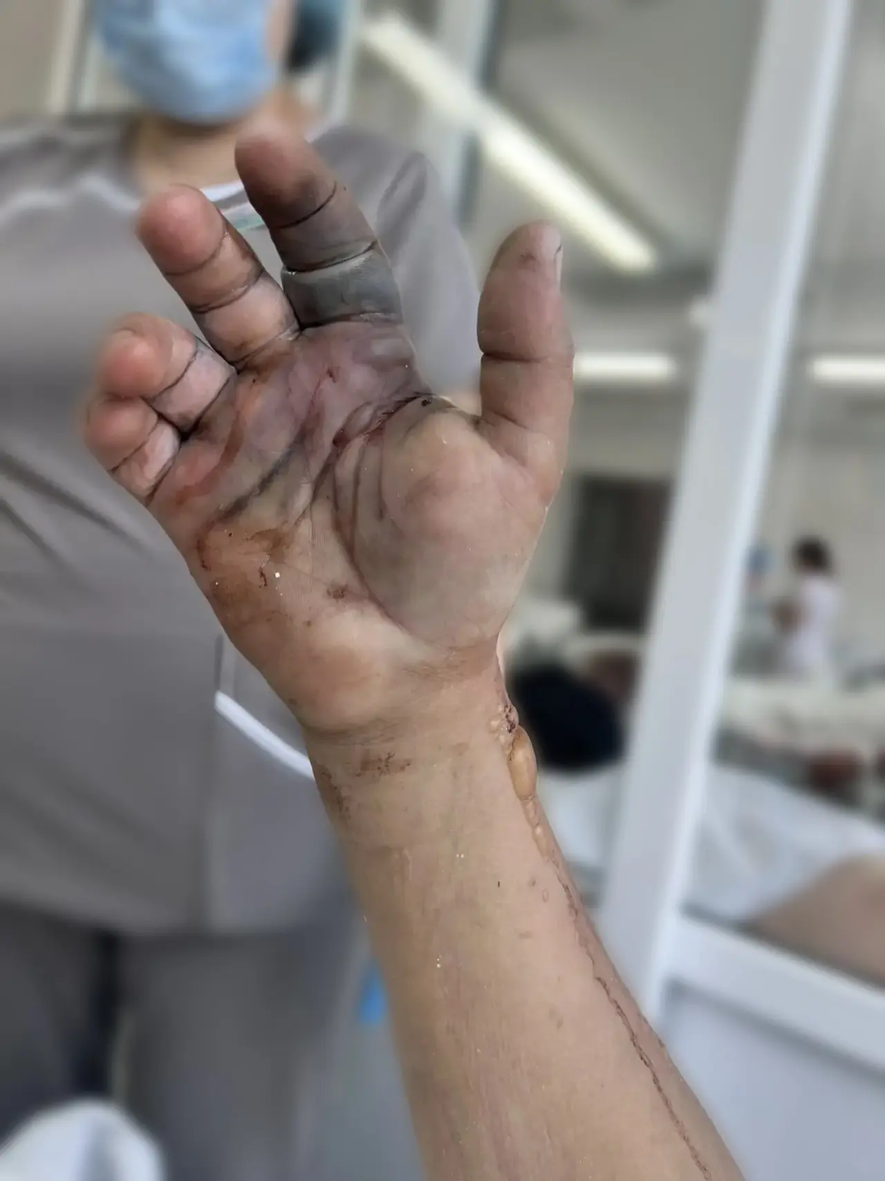 🐍 Укус гадюки — и сразу в реанимацию