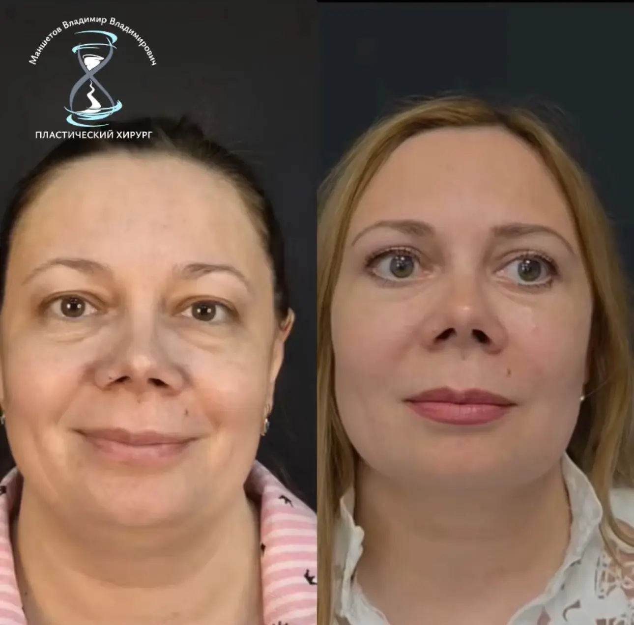 3 месяца после верхней и нижней блефаропластики

До:
✔️выраженные мешки под глазами
✔️усталый взгляд