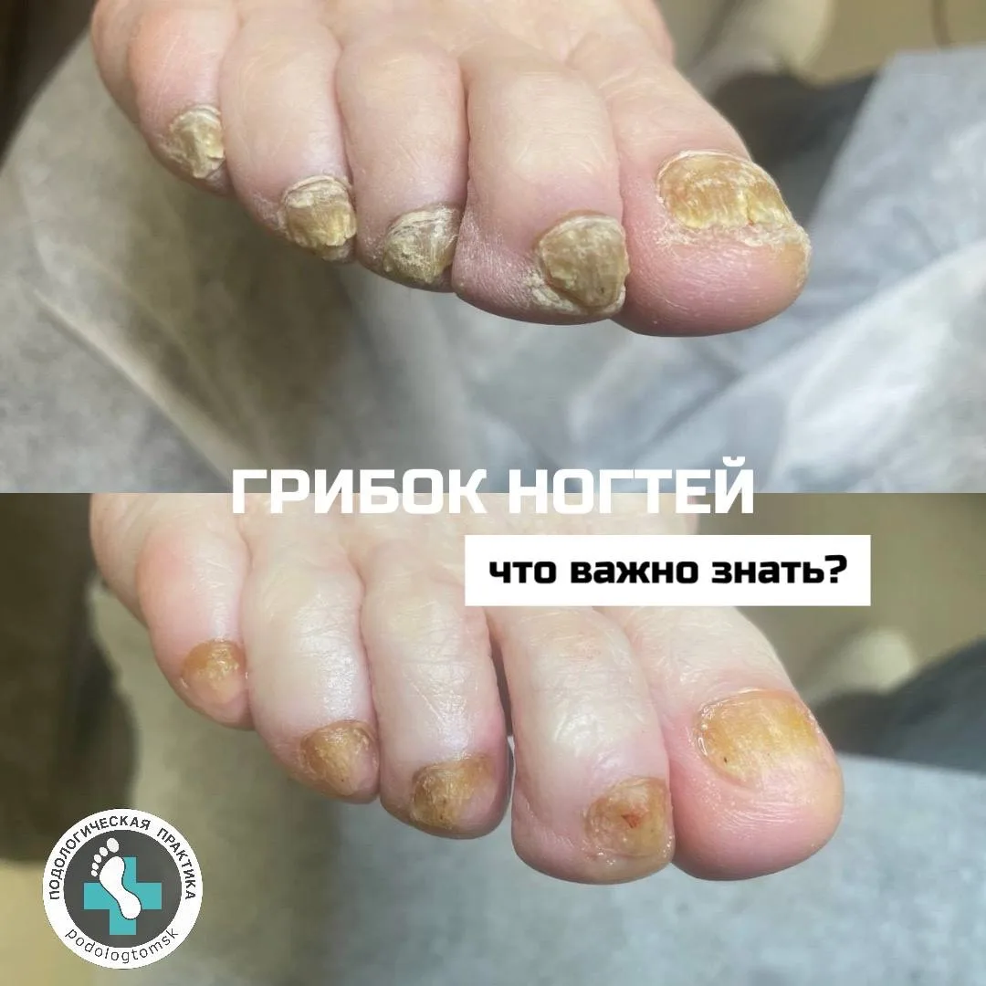 Грибковая инфекция ногтей: что важно понимать?