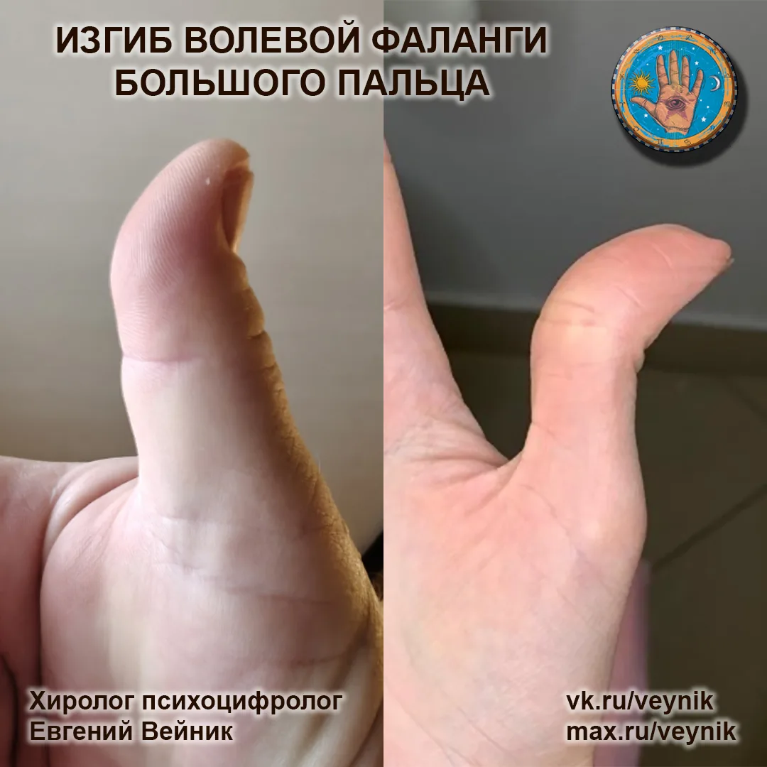 Сильный изгиб волевой фаланги большого пальца: новый взгляд

✅ Речь идет о верхней, ногтевой фаланге
