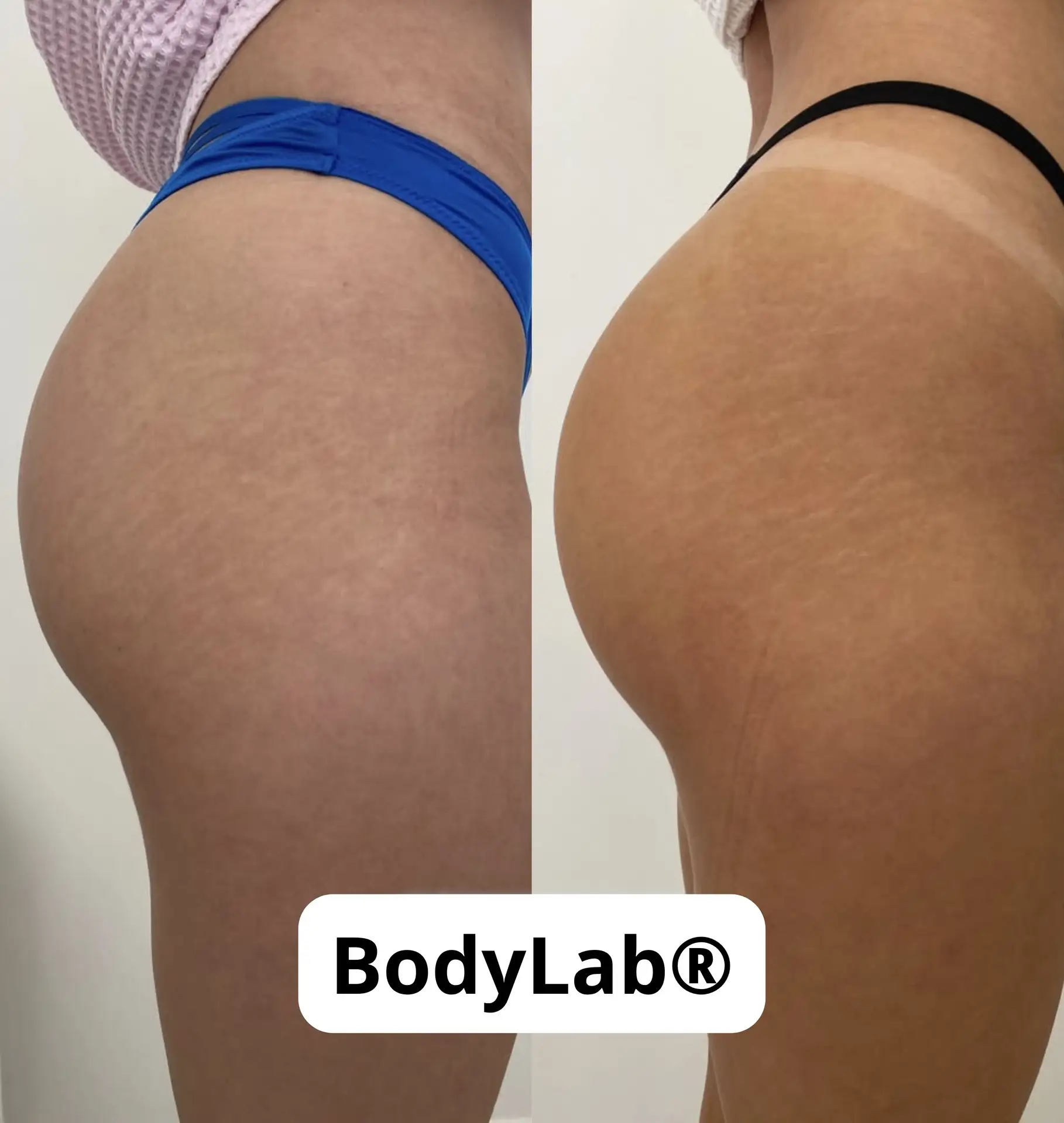 BodyLab® – технология скульптурирования тела на основе сфокусированной магнитной стимул...