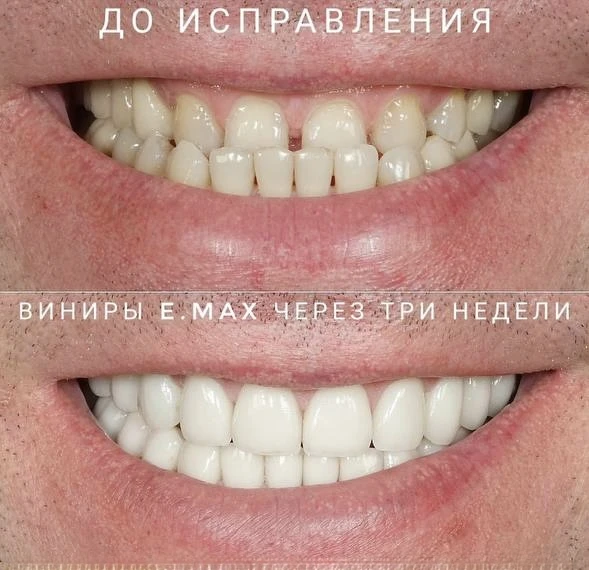 "Ортониры" - как за счёт виниров "исправили" прикус.