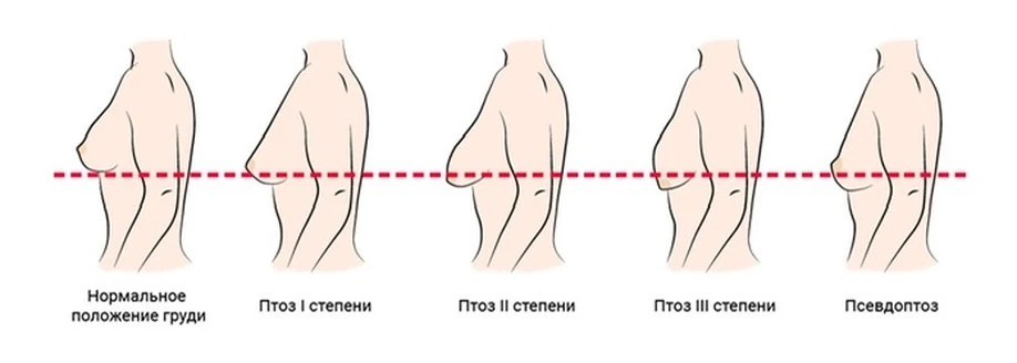 Почему грудь опускается и что с этим можно сделать ?
