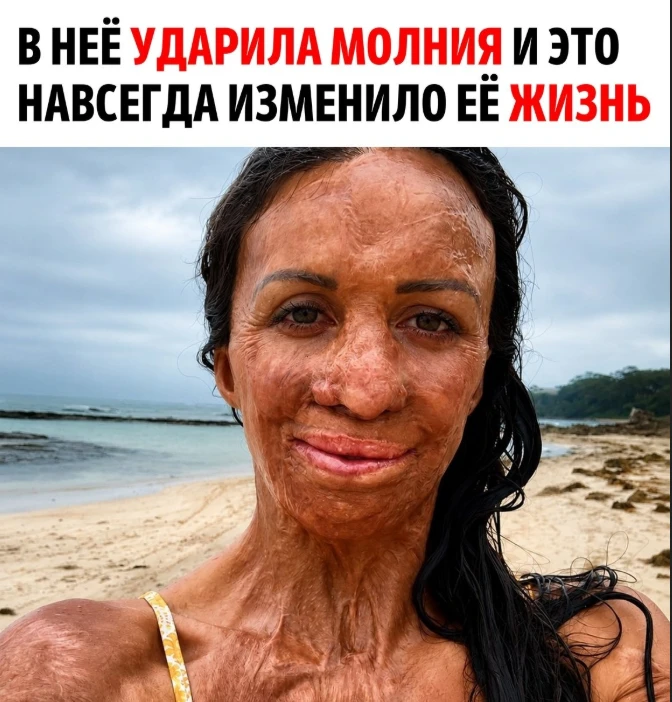 Молния прошла через всё её тело

Во время сильной грозы девушка оказалась на открытой местности. В о