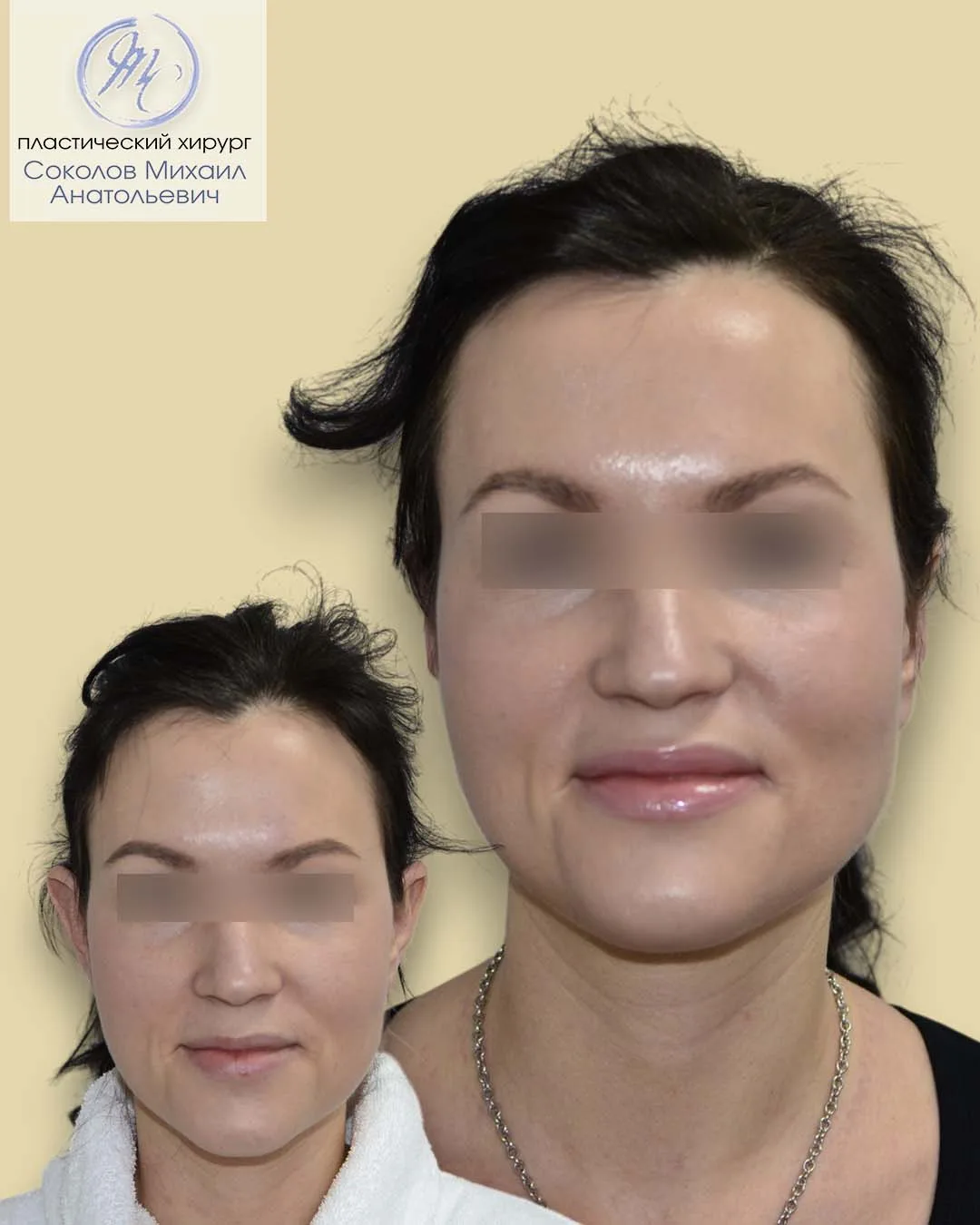 Отопластика. Исполнение детской мечты.