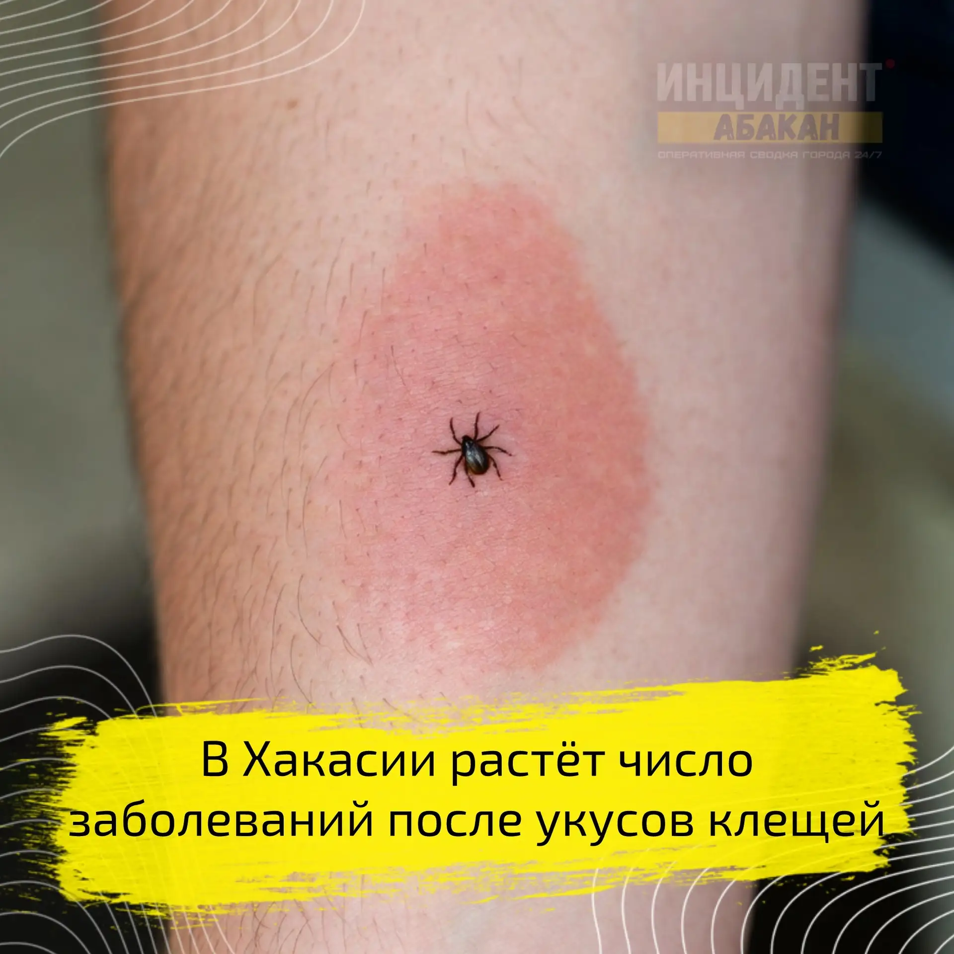 Опасные укусы в Хакасии ⚡️

В республике зафиксировано увеличение числа заболевших энцефалитом после
