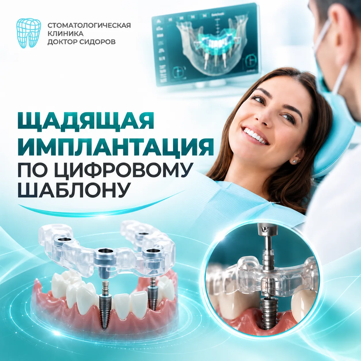 🀄Щадящая имплантация без отеков и синяков благодаря цифровому шаблону