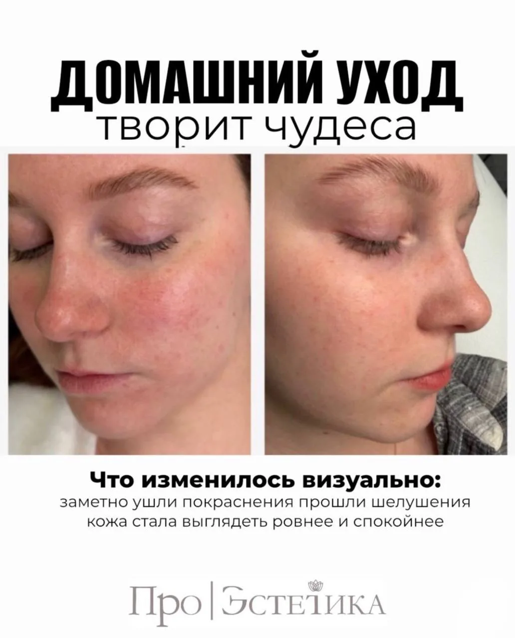 1️⃣ После умывания кожу сильно стягивает — это нормально?