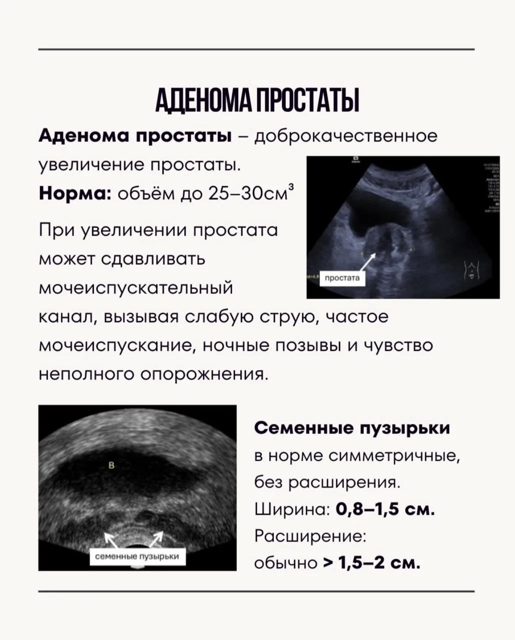 🔺УЗИ-атлас простаты и семенных пузырьков