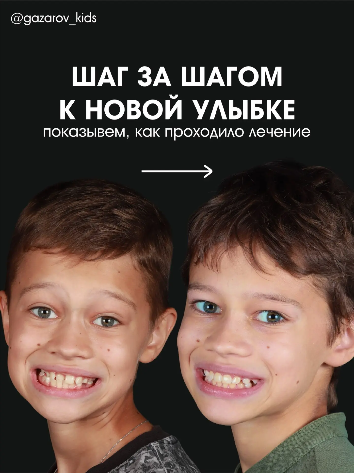 Ну и конечно, в день ортодонта — ортодонтический кейс! 🤩
