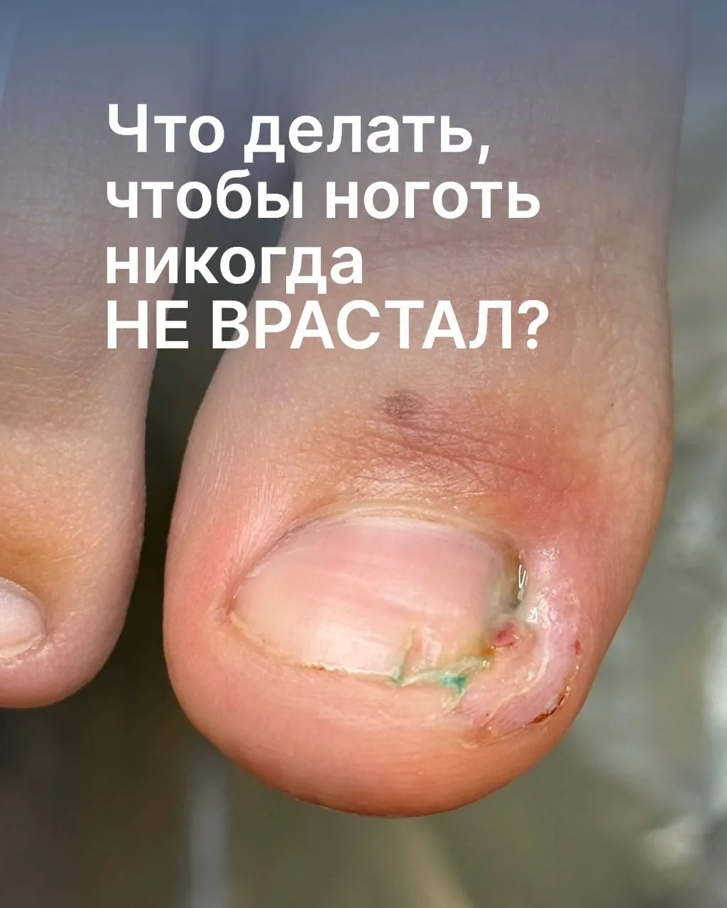 «А что сделать, чтобы ноготь больше никогда не врастал? Может поставим систему, чтобы э...
