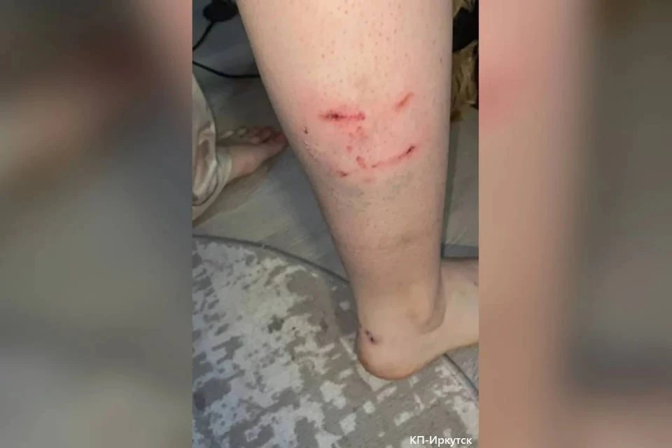 😠 Бродячая собака прокусила ногу 15-летней школьнице в Братске: СК начал проверку