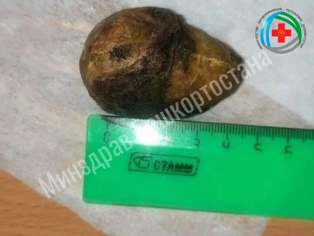 ⚡️Врачи Башкортостана спасли пожилую пациентку от редкого осложнения желчнокаменной бол...