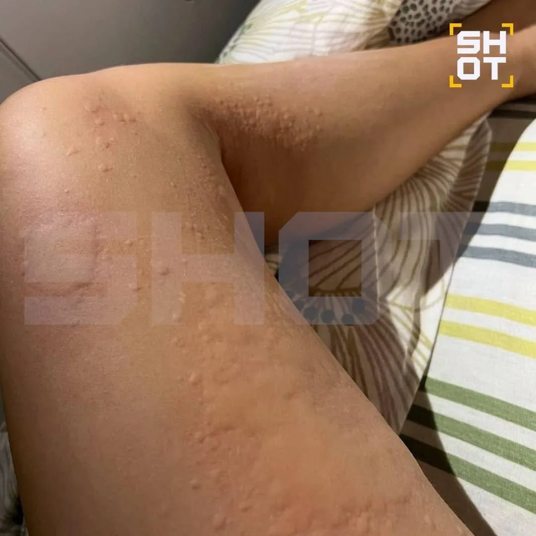 😳 Кишечную инфекцию подхватила петербурженка в Китае и покрылась красными пятнами.