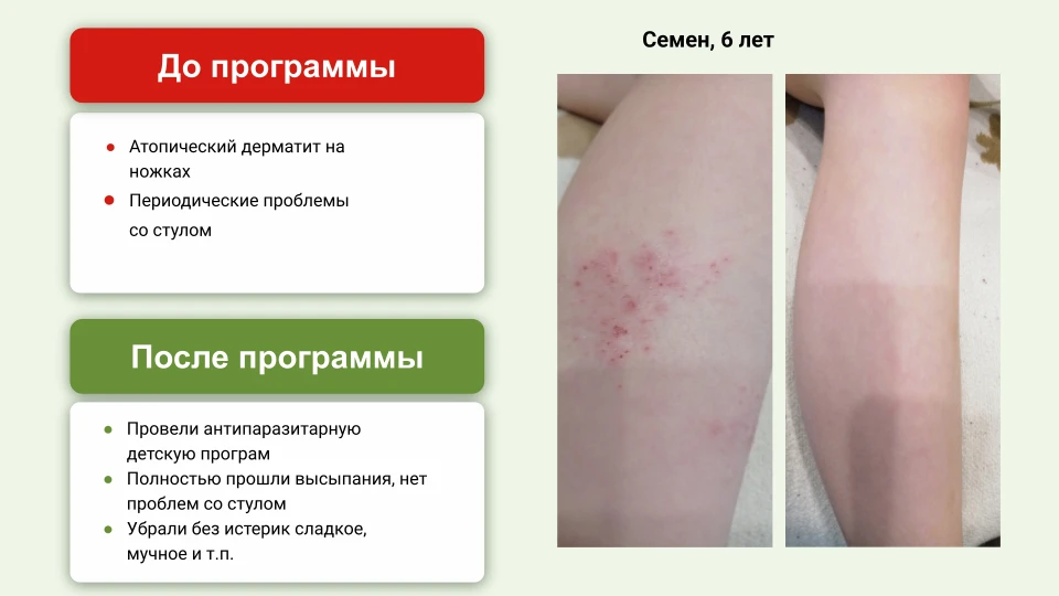 Вся кожа в акне, экземе, псориазе? Возможно, причина не в гормонах и не в аллергии.

Привет, мои хор
