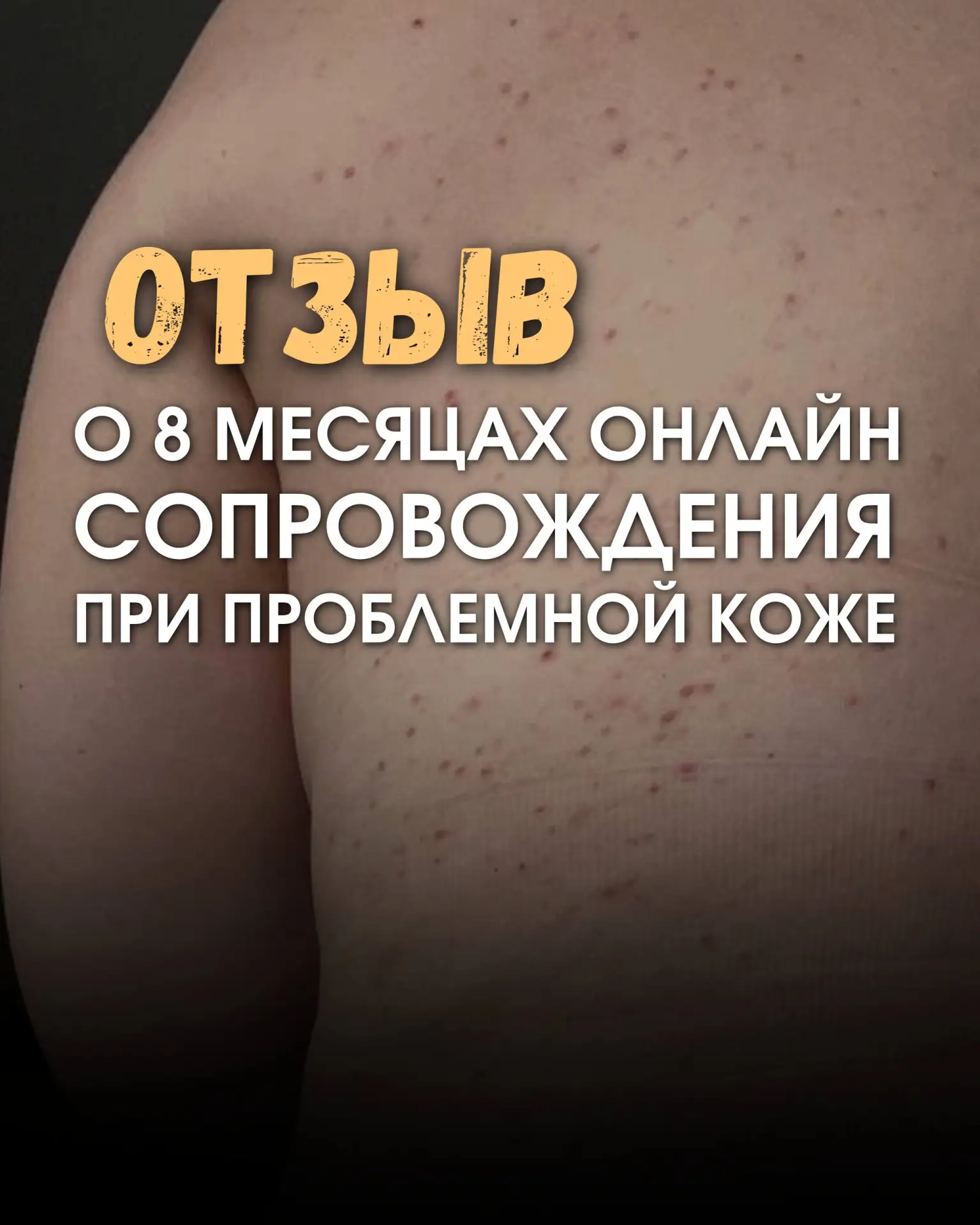 Отзыв после онлайн сопровождения при акне ❤️
Послушайте эти эмоции и полюбуйтесь фоторезультатами.

