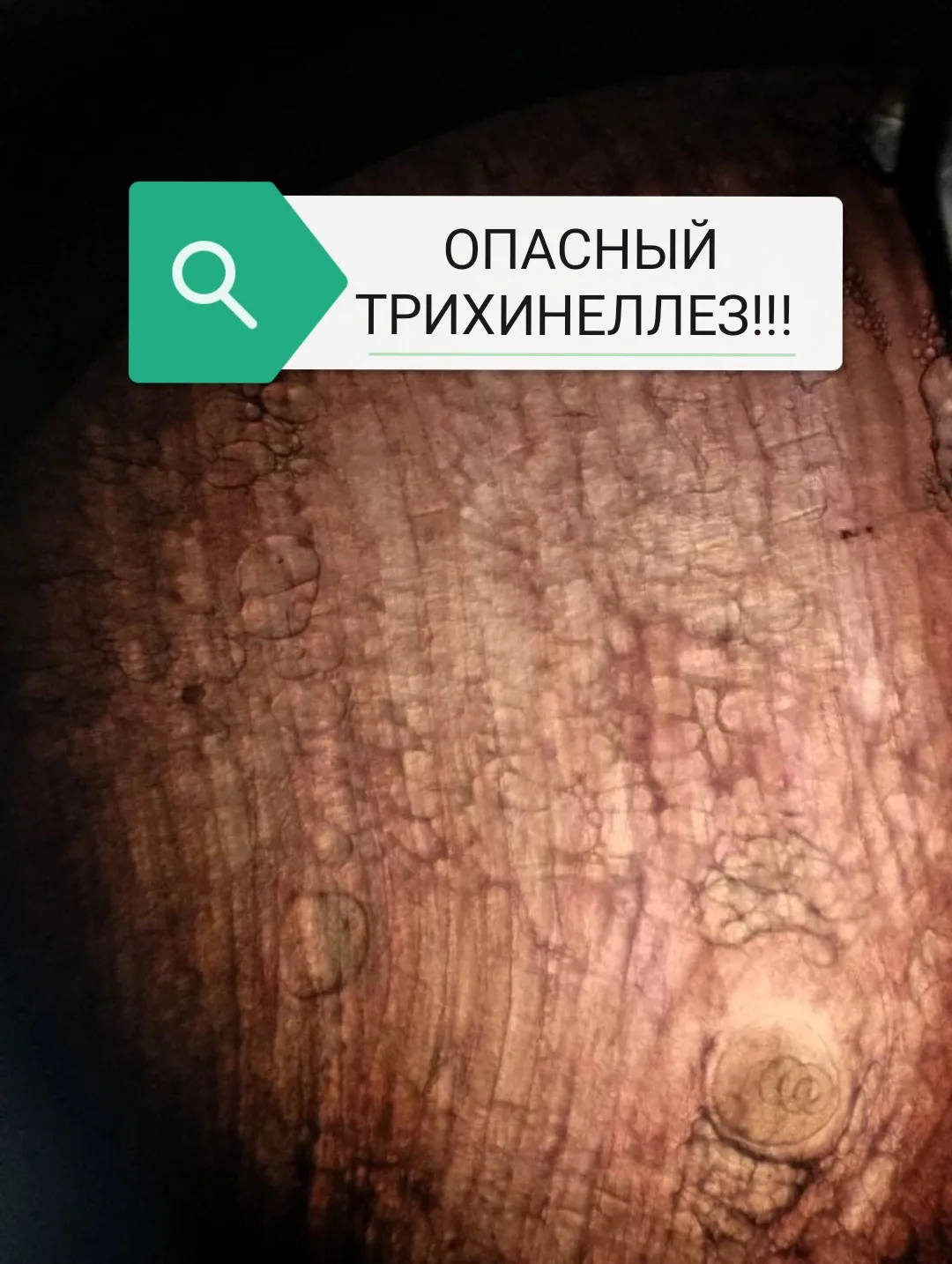 📌Опасный трихинеллёз. Что важно помнить?