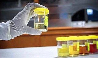 Зачем нужен общий анализ мочи?