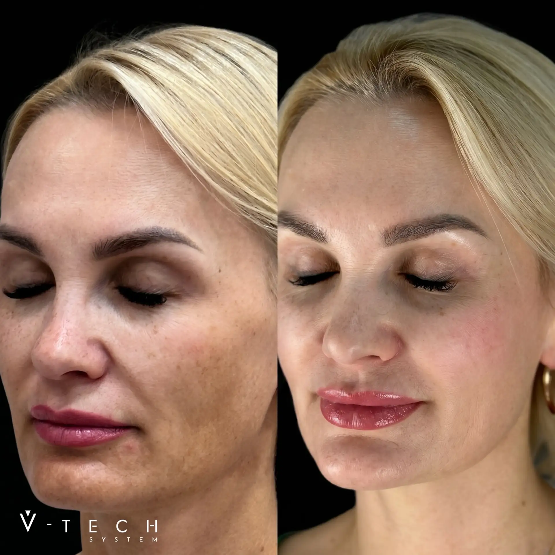 Кейс: пациентка 45+ с мелкоморщинистым – усталым типом старения