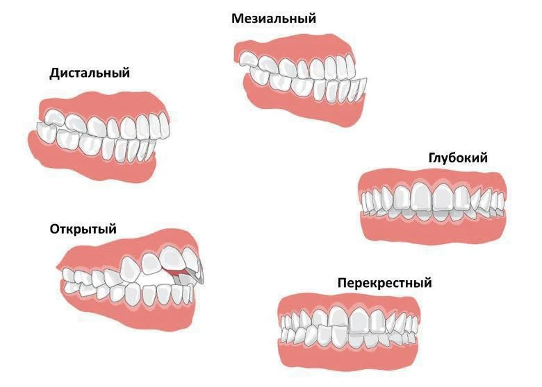 🦷 Если вы носите брекеты, элайнеры, проходите расширение верхней челюсти или планирует...