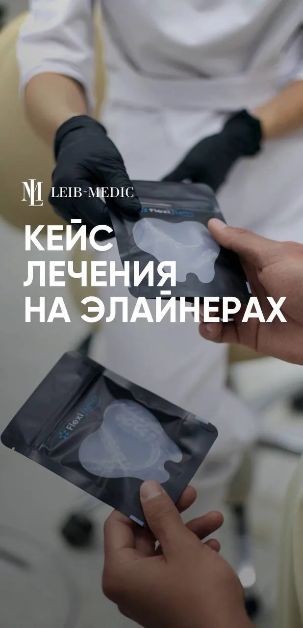 Элайнеры - прозрачные ортодонтические капы для исправления прикуса, невидимая альтернат...