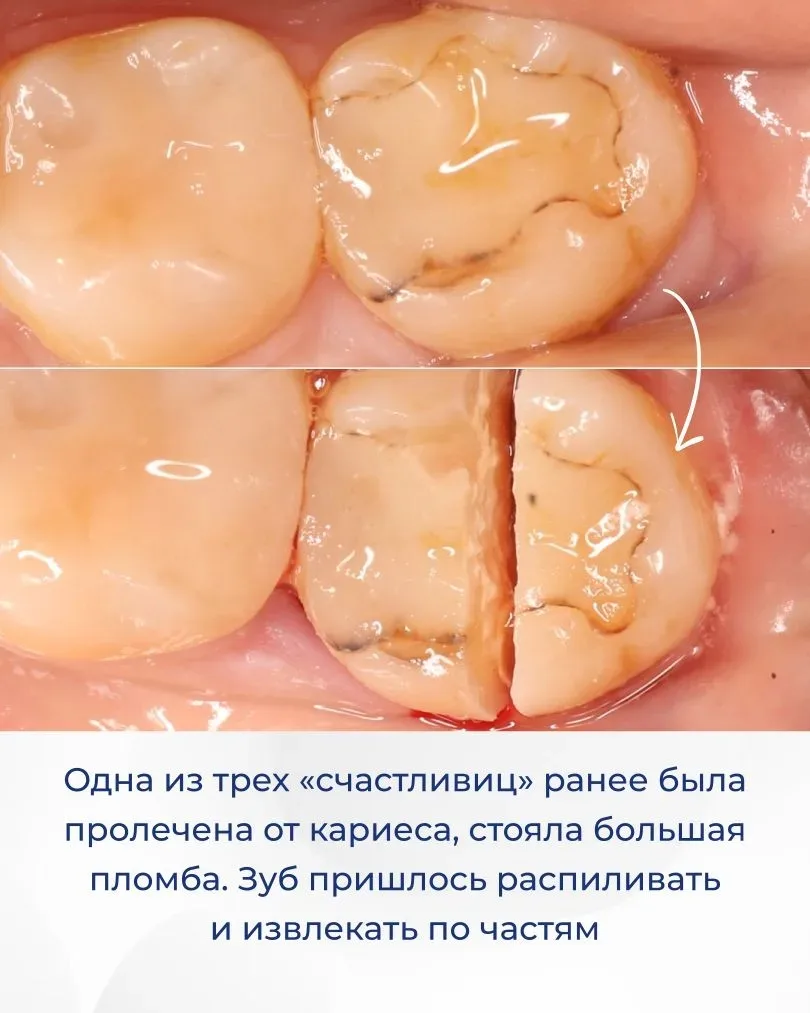 Сразу три зуба удалили пациентке всего за один прием. Это восьмые зубы. Они никак ее не беспокоили и