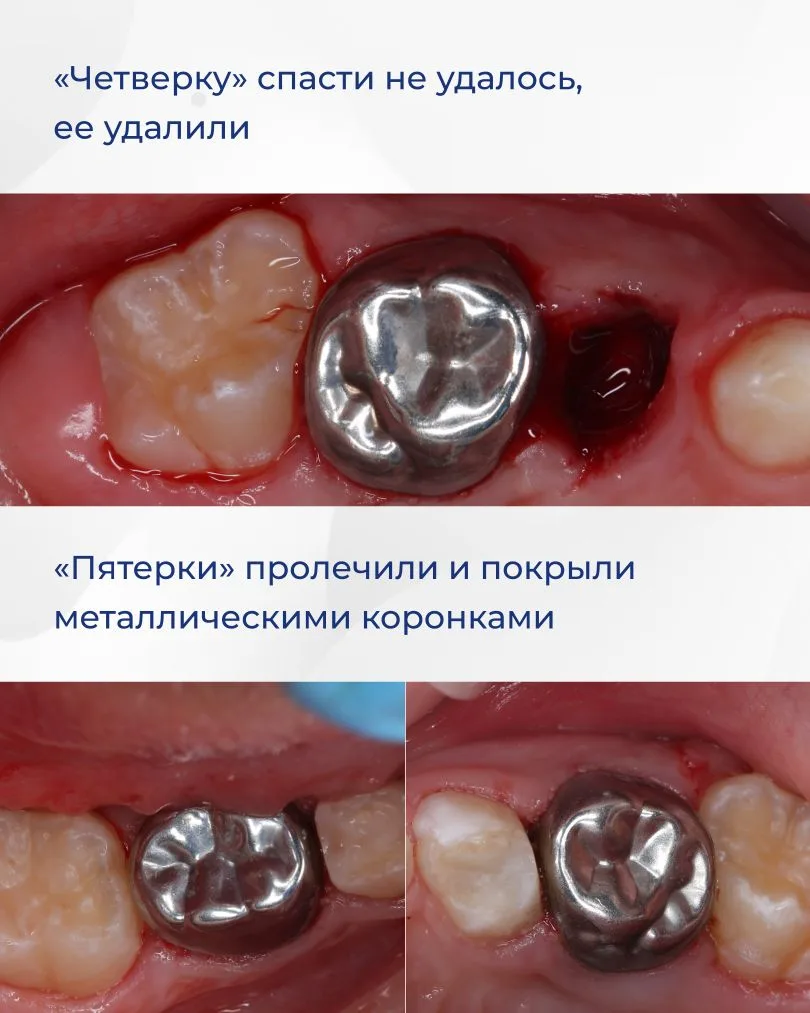 Недостаточно тщательная домашняя гигиена может привести к множественному поражению зубов. Именно это