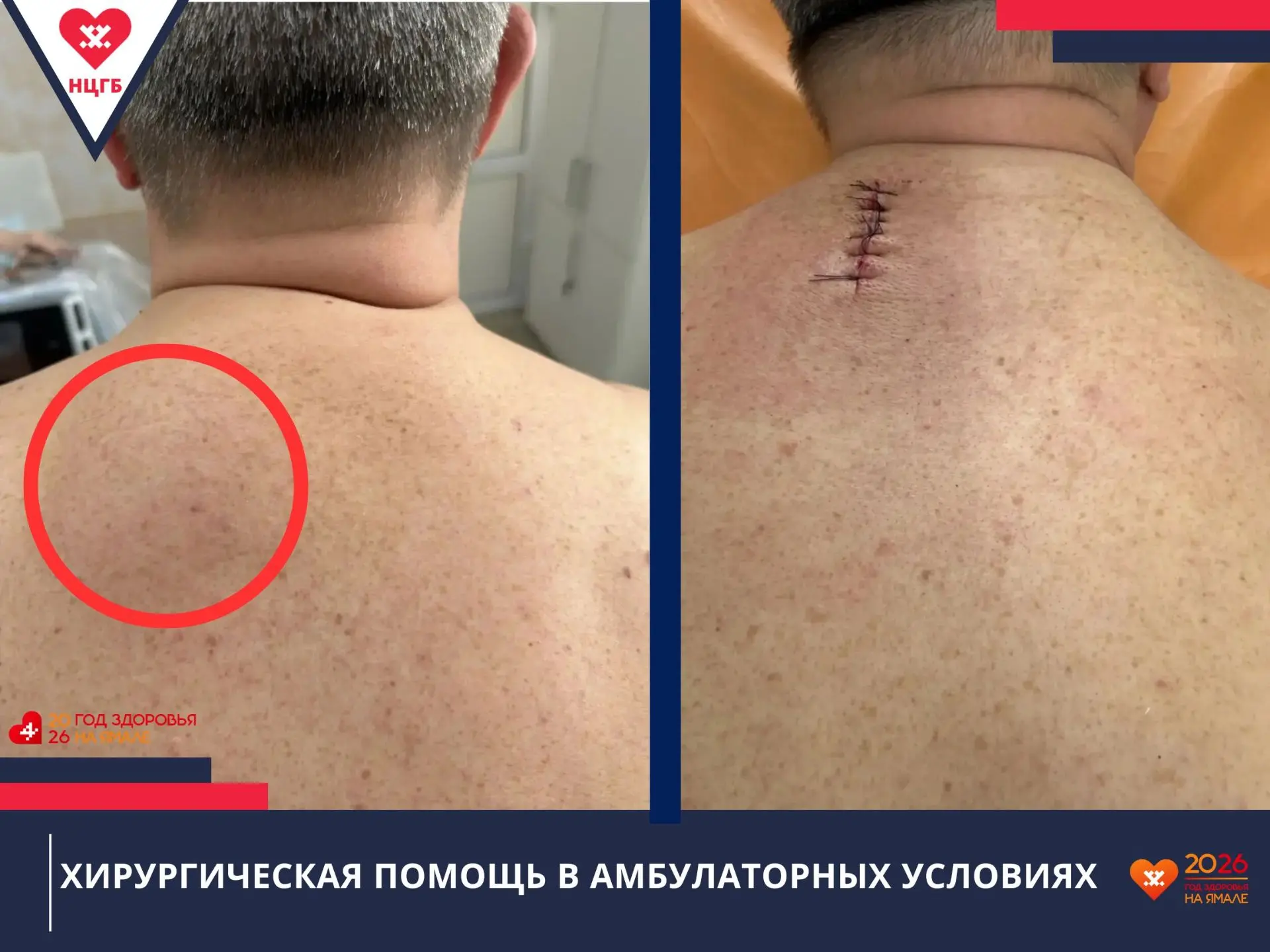Объемные хирургические вмешательства доступны в амбулаторных условиях

👨‍💼Врачи поликлиники №1 про