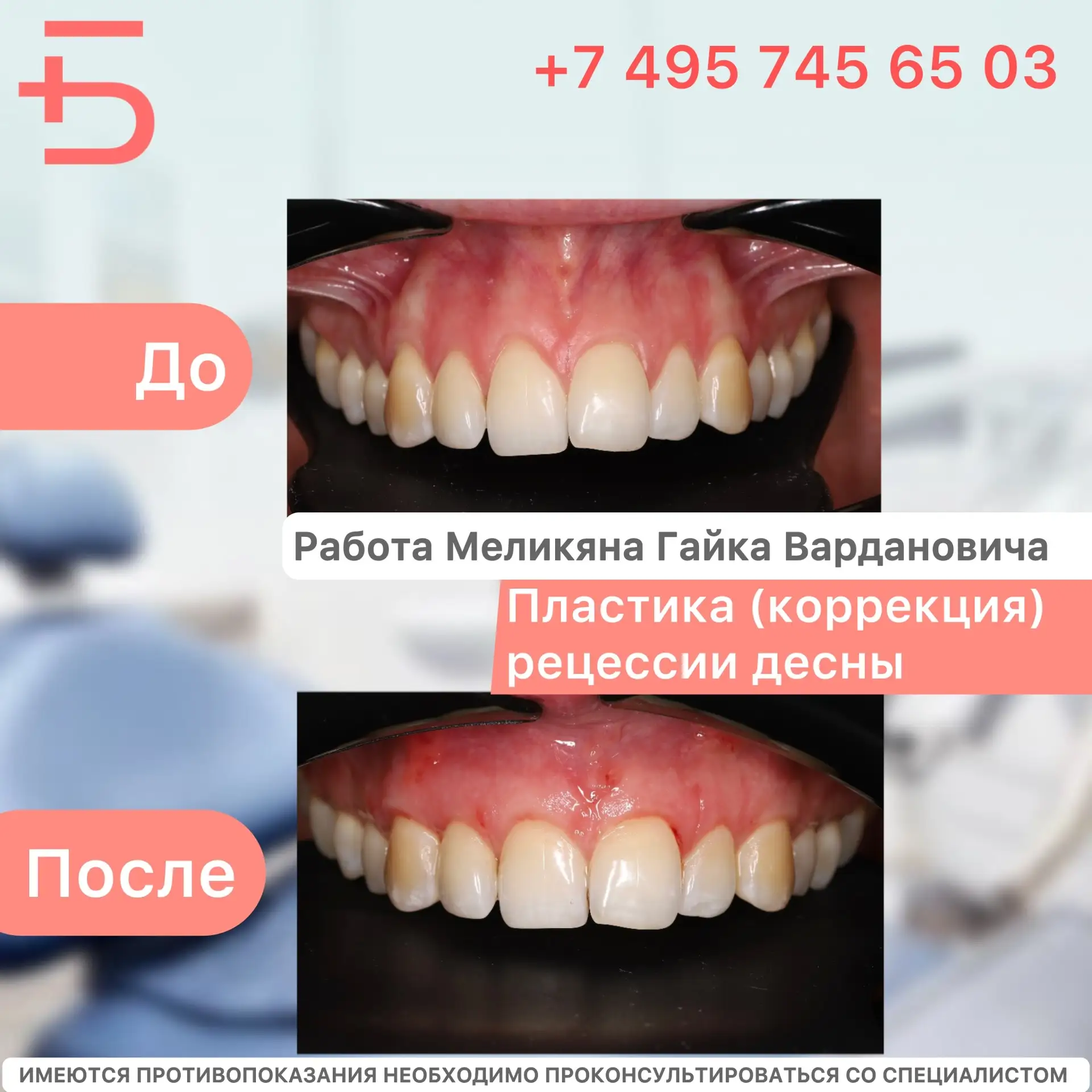 Сегодня хотим поделиться  результатом работы нашего специалиста — врача-стоматолога, челюстно-лицево