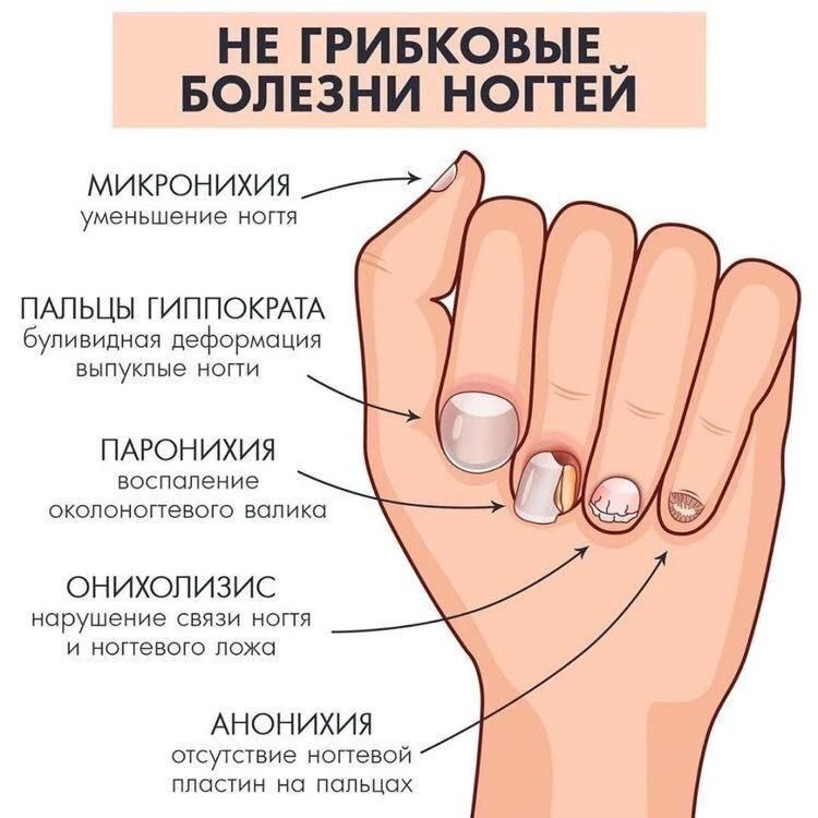 🍄‍🟫 Не грибковые болезни ногтей