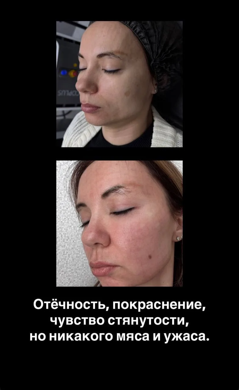 На следующий день в норме отёчность, покраснение, чувство стянутости, но никаких корок ...