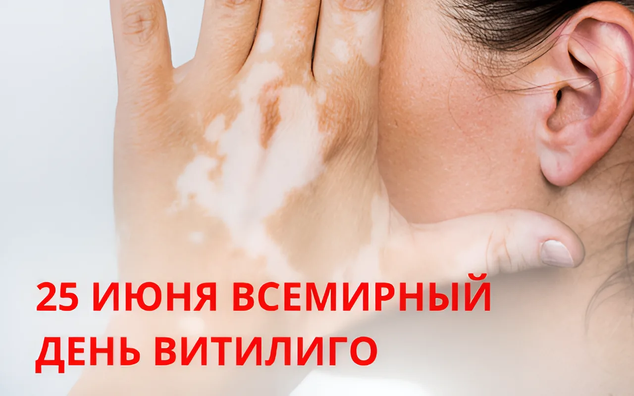 🧬 25 июня — Всемирный день витилиго

❓ Что такое витилиго?
Витилиго (пегая кожа) — это хроническое 