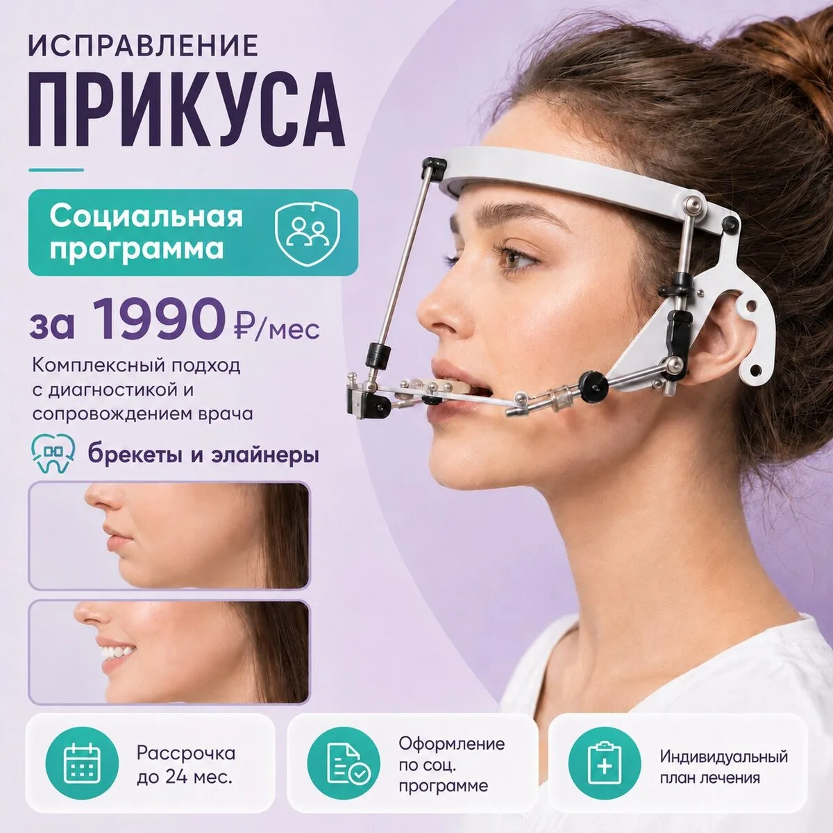 Установка брекетов и элайнеров за 1990₽/мес