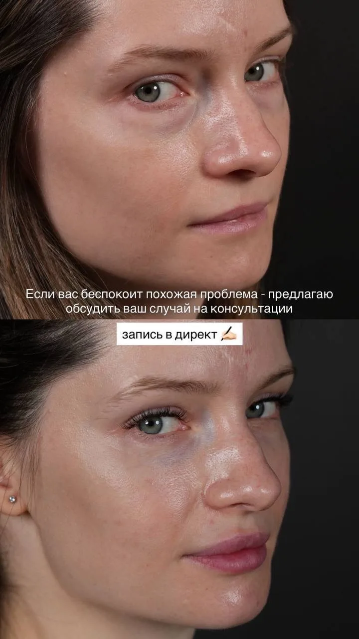 1,5 месяца после нижней блефаропластики 👀