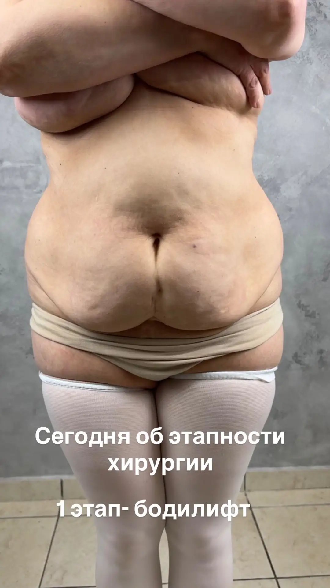 Этапная хирургия, чтобы осуществить мечту