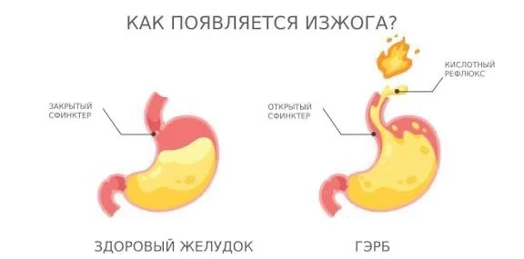 Почему изжога усиливается именно сейчас?