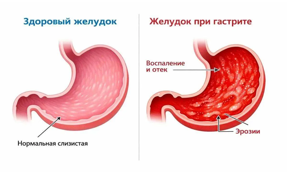 🔥 Проблемы ЖКТ требуют грамотного решения вопроса о питании

Дорогие ❤
Подчеркну: диагнозы не вырас