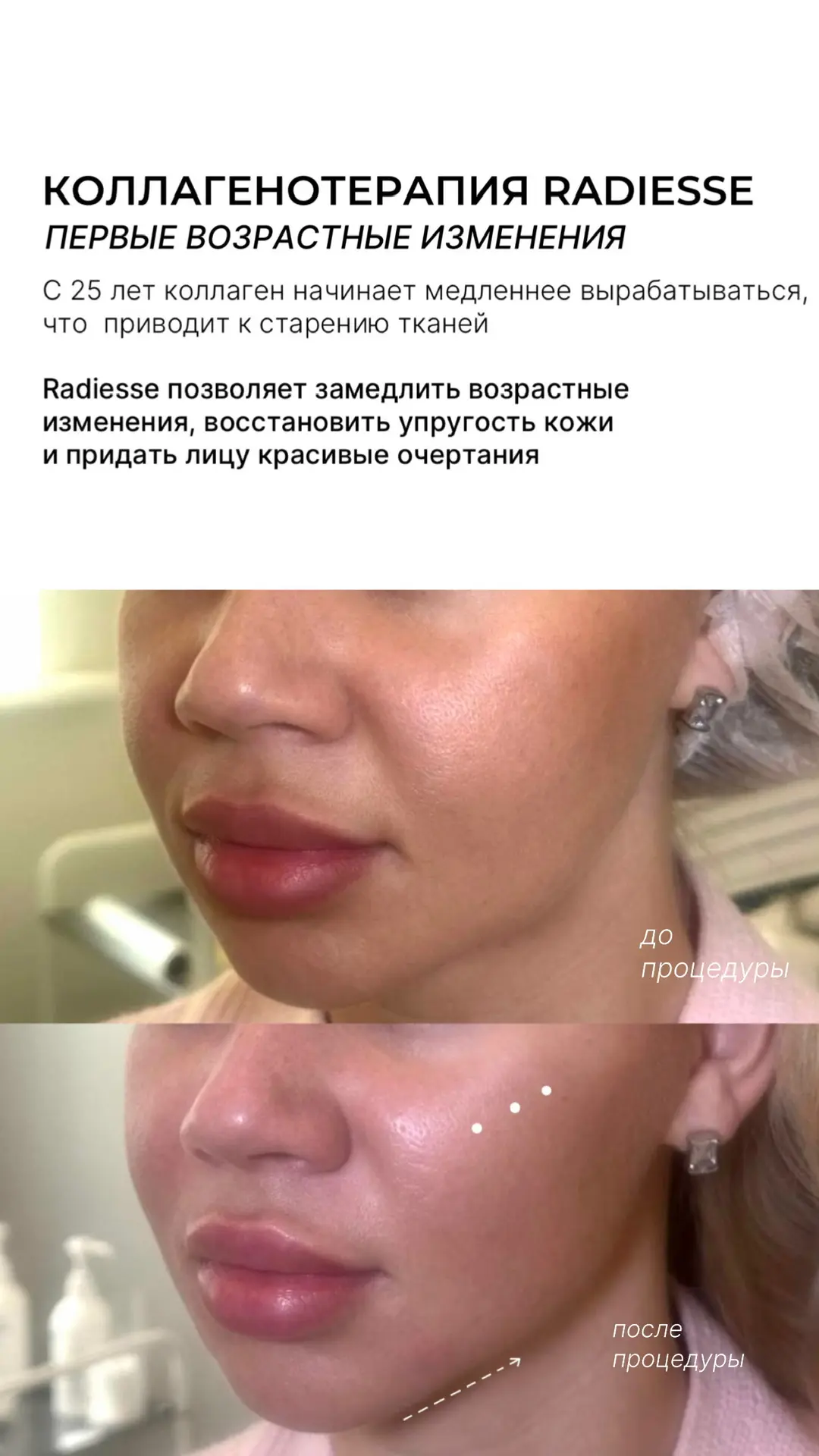ЛИФТИНГ БЕЗ ОТЕКОВ🤍
