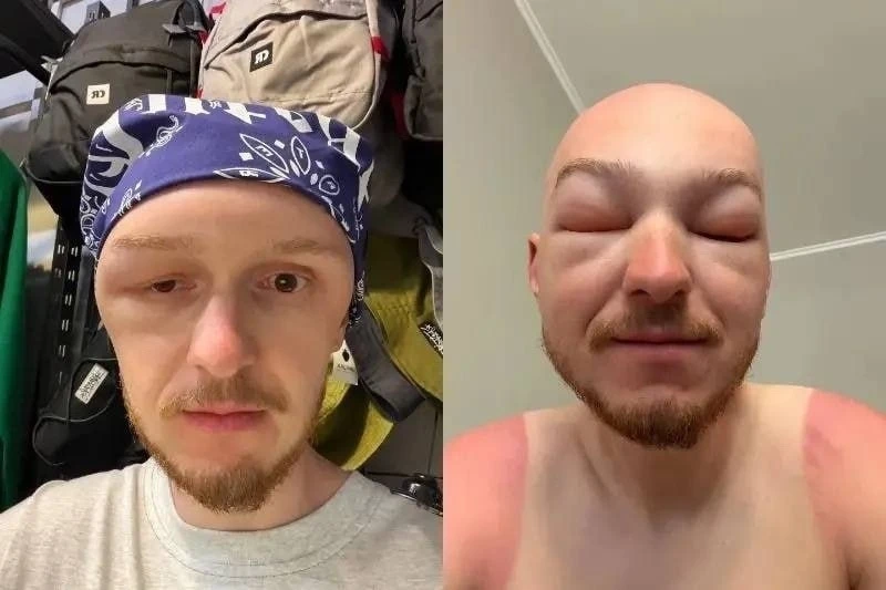 😱Сильный отёк головы из-за солнца случился у жителя Новосибирска после прогулки на сапе