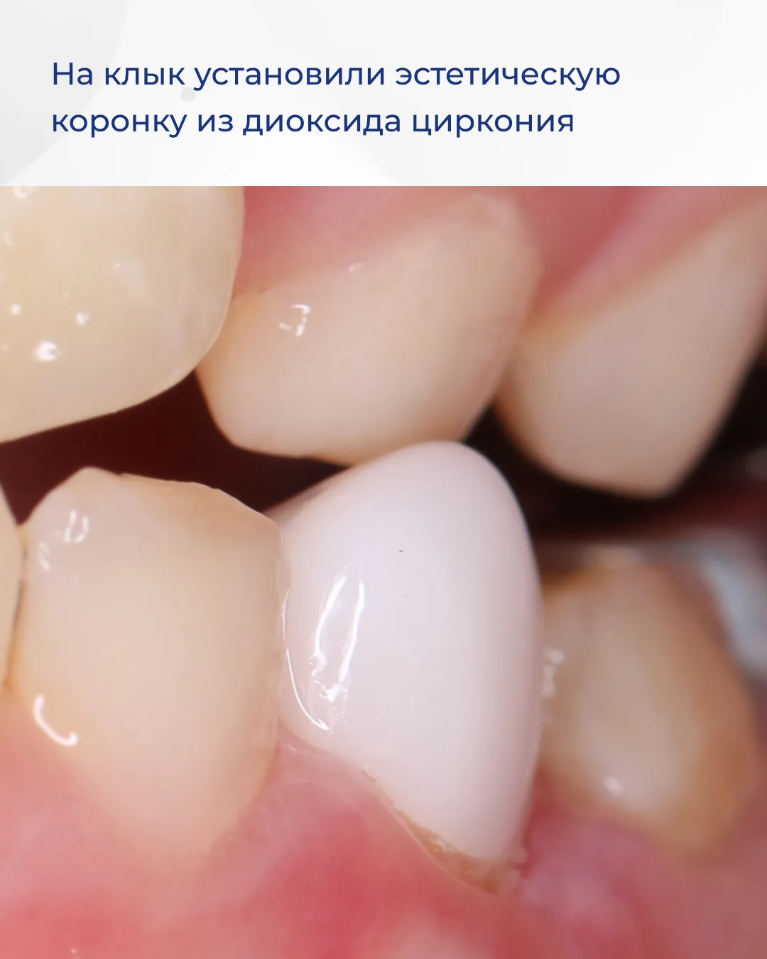 Недостаточно тщательная домашняя гигиена может привести к множественному поражению зубов. Именно это