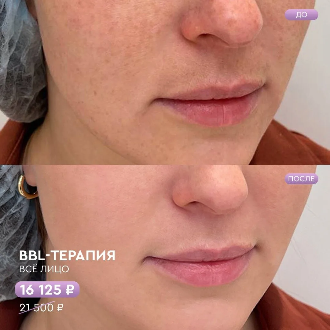 BBL фототерапия и омоложение кожи со скидкой до 25%