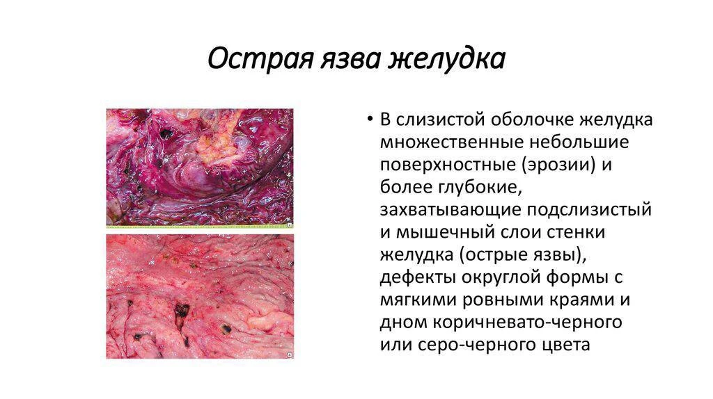 Язвенная болезнь - это хроническое (то есть оно сразу не образуется, должно быть длител...