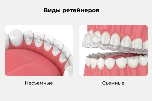 Рекомендации после снятия брекет-системы